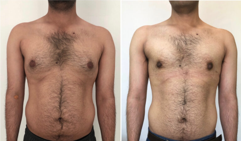 Grade 1 Gynecomastia- Daycare Surgery