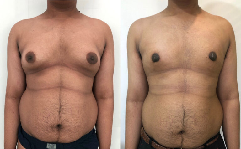 Grade 3 Gynecomastia- Without visible scarring