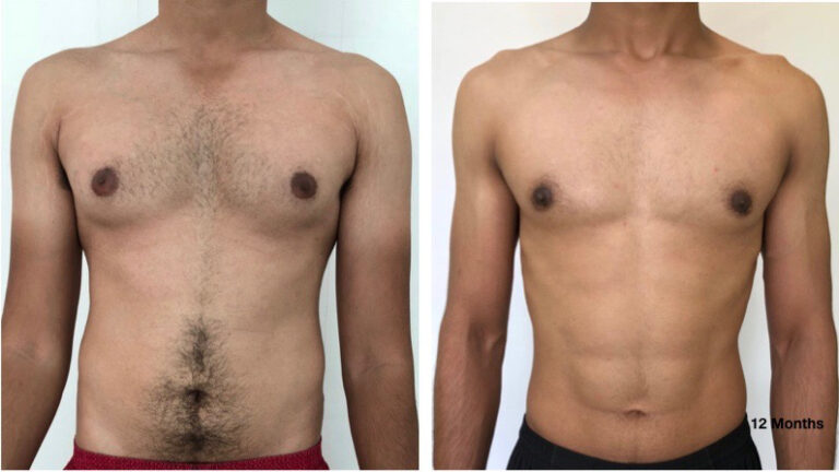 Grade 1 Gynecomastia- Surgery time 60mins