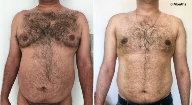 Grade 2B Gynecomastia- Dissolvabe Stitches