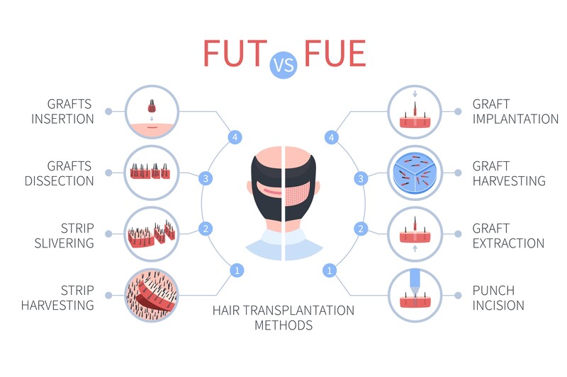 FUE transplant clinic