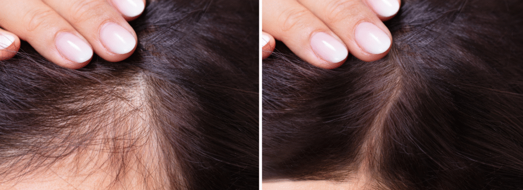 best hair treatment in Bangalore 
